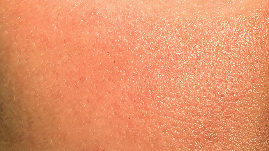 Peau sèche