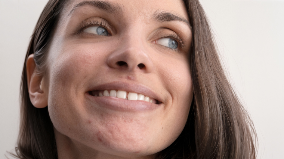 Peaux à tendance acnéique : une routine personnalisée pour chaque type d’acné  