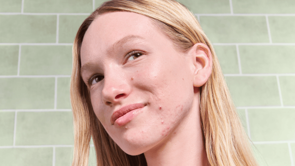 Blog: Acn&eacute; hormonale : comprendre ses causes et apaiser les pouss&eacute;es