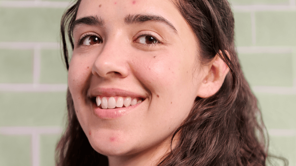 Blog: Acn&eacute; inflammatoire : origines, signes cl&eacute;s et solutions apaisantes