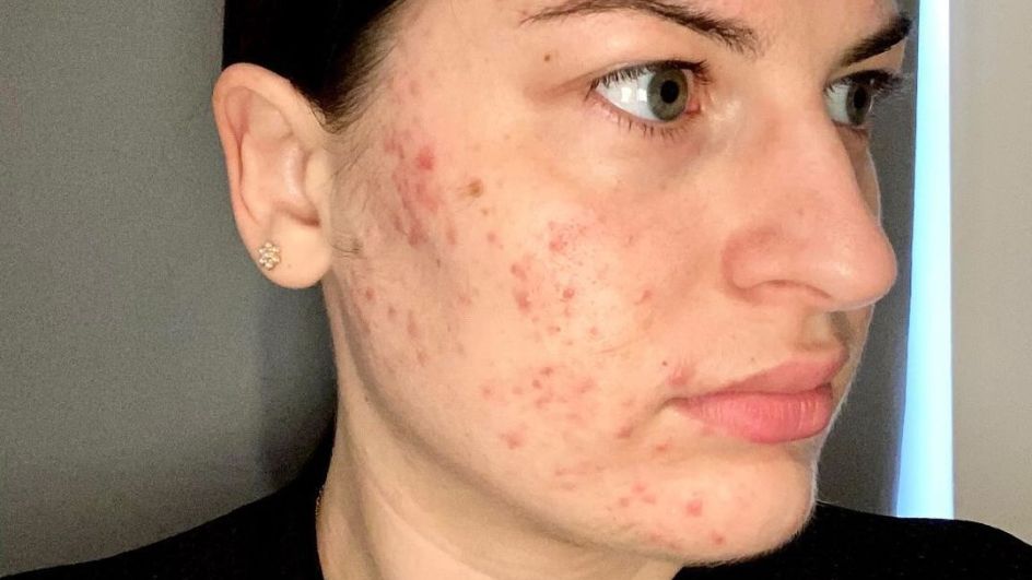 L'avant / après impressionnant d'Alexandrine pour son acné