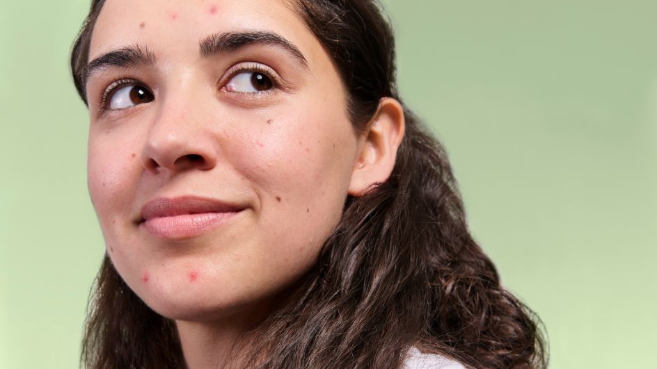 Blog: Comprendre et traiter l'acné juvénile