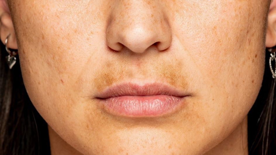 Masque de grossesse : comment s'en débarrasser ?