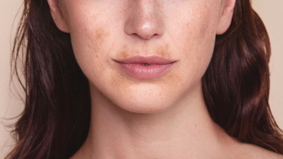 Blog: Taches brunes sur le visage : causes et solutions